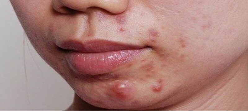 Nốt mụn mủ thường có kích thước khoảng 5mm đến 10mm và chứa dịch mủ (Nguồn: Internet)